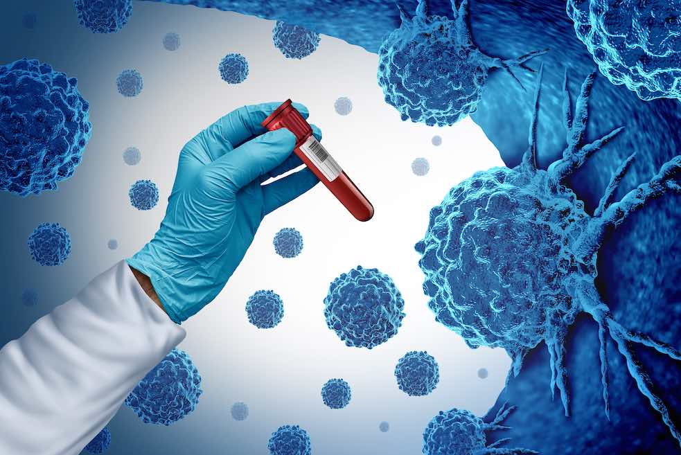 Cancer Screening & Diagnosis
