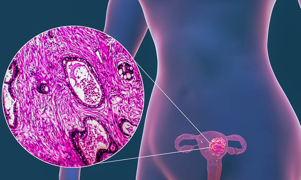 Endometrial (Uterine) Cancer